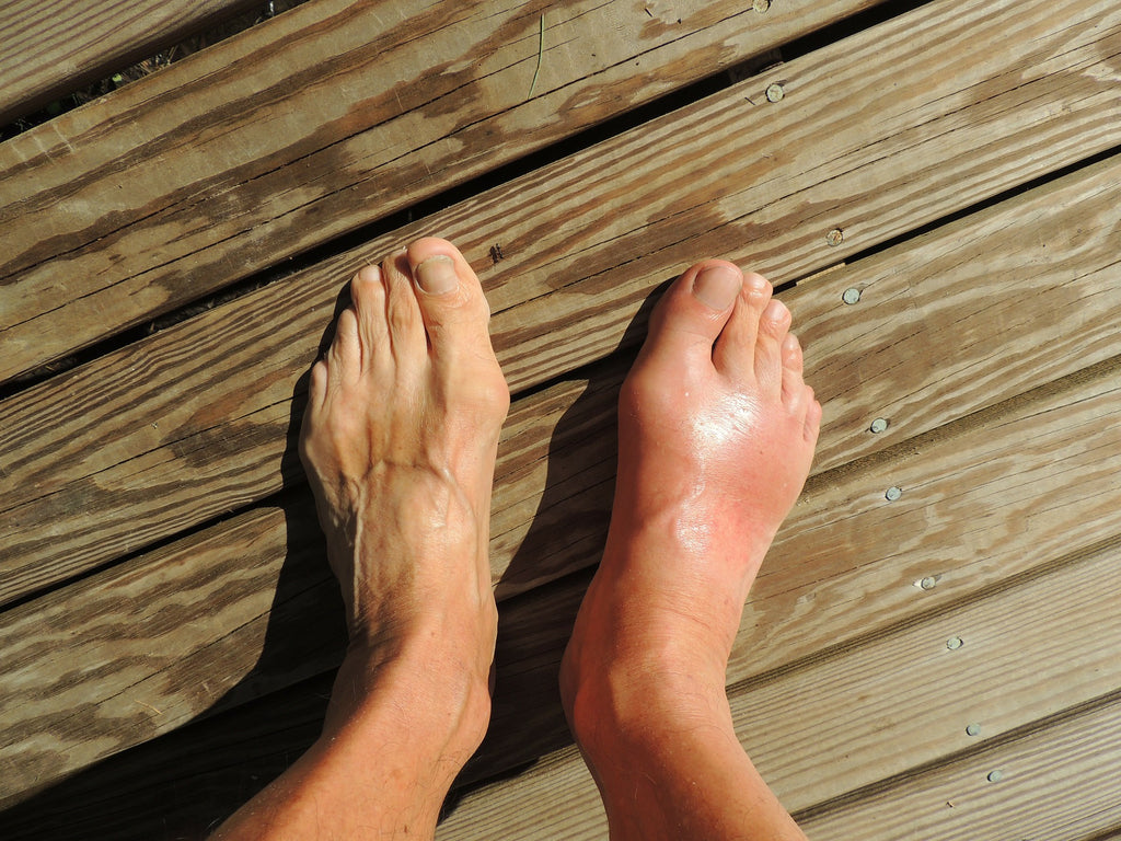 How CBD Oil Can Help People Suffering From Gout